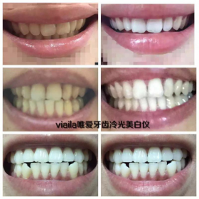 唯爱牙齿冷光美白仪风靡全球为美牙而来