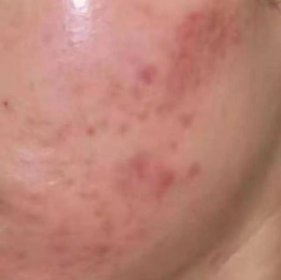 跟着美妆博主刷酸致“烂脸”！自己刷酸真的安全吗？